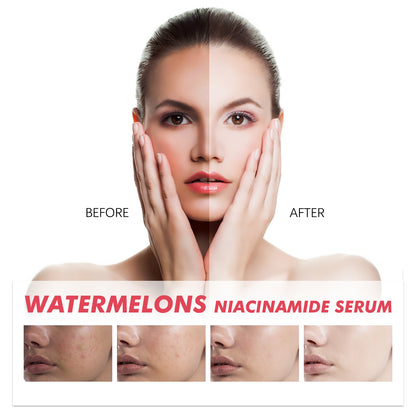 EELHOE Watermelons Niacinamide Serum, Dilute Spots Firming Haun White Skin Hydrating Moisture Essence