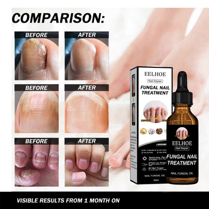 EELHOE Nail Repair Solution Thickening And Brightening Nails Removing Gray Nail Repair Nourishing Nail Care Solution